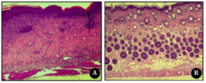 comparatif peau inflammée